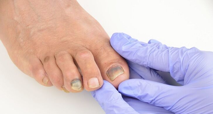 Check for fungus on toenails