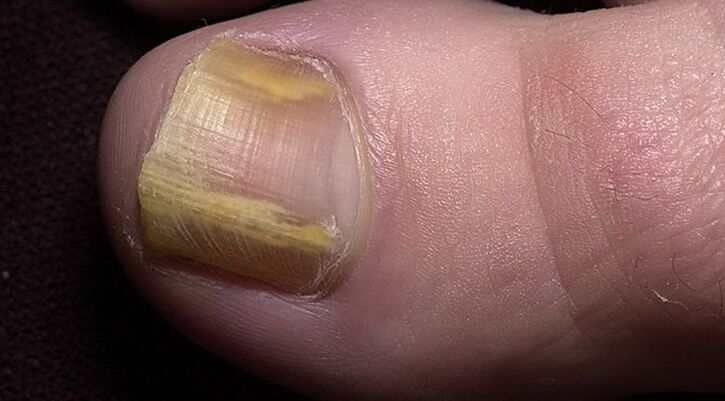 Damage to toenails caused by fungal infections