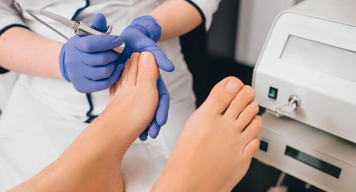 Professional treatment of toenail fungus