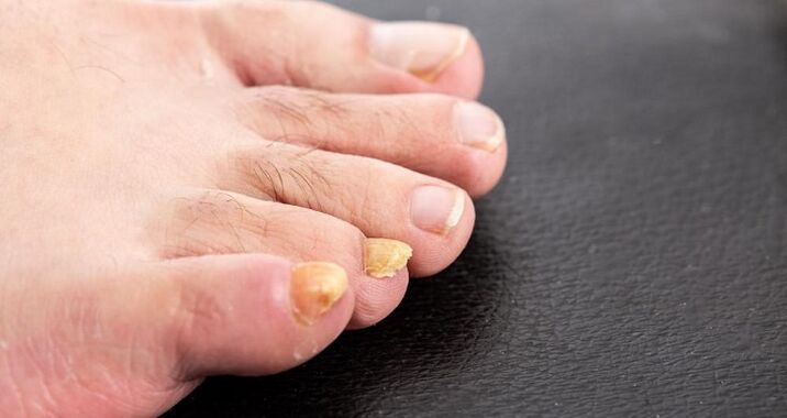 Yellow nails with nribka on the feet