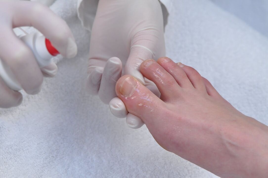 Treat toenails with fungus