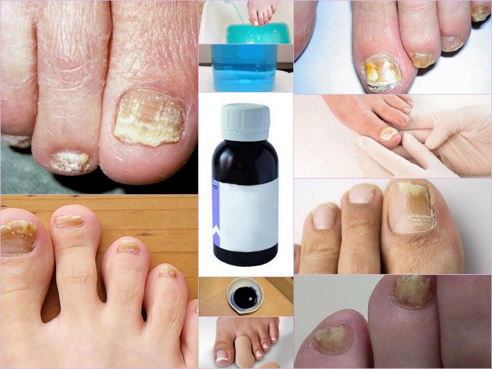 Drugs for toenail fungus