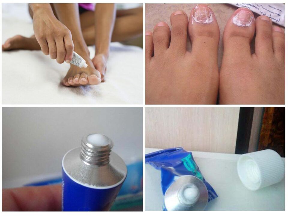 Effective pharmaceutical preparations against nail fungus