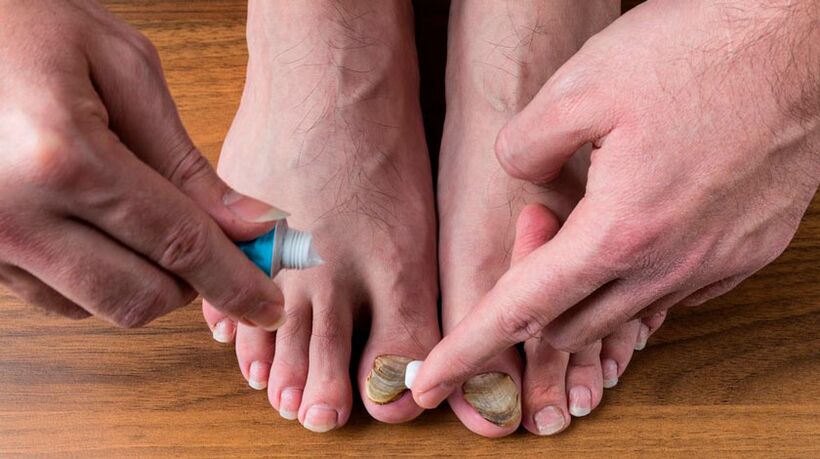 Apply anti-fungal cream on toenails to treat onychomycosis