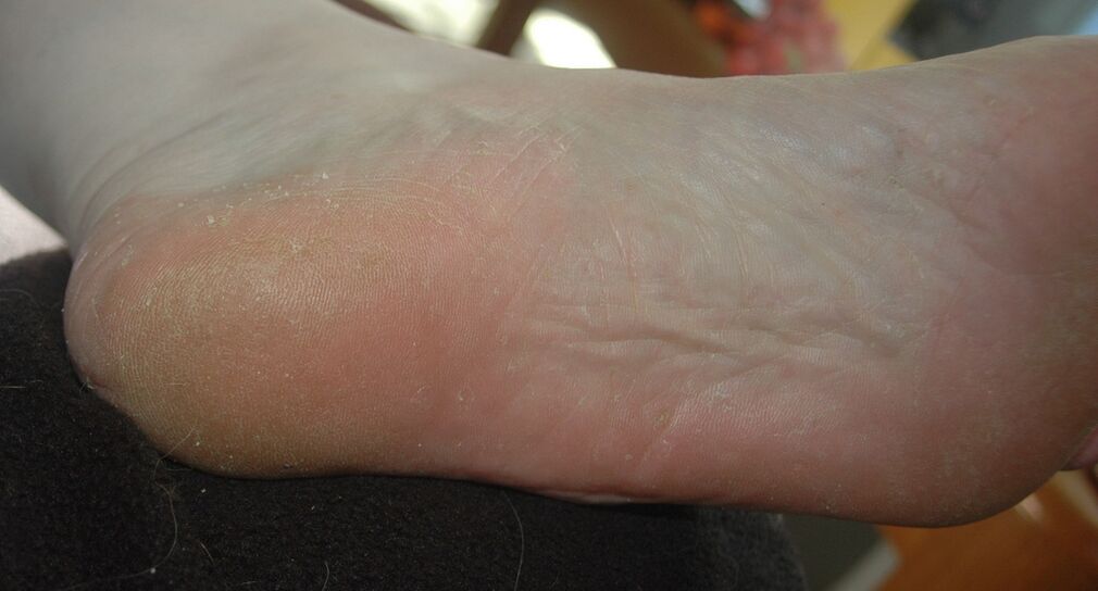 Scaly hyperkeratosis form of foot fungus