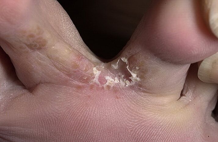 Cracked skin between the toes is a symptom of intertrigal fungus