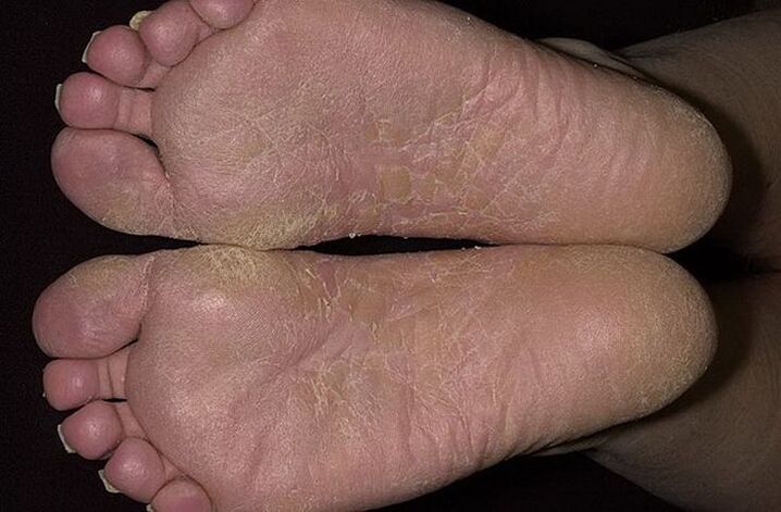 Dry, flaky skin on the feet is a sign of squamous mycosis