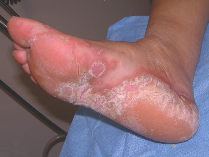 Feet affected by a fungal infection