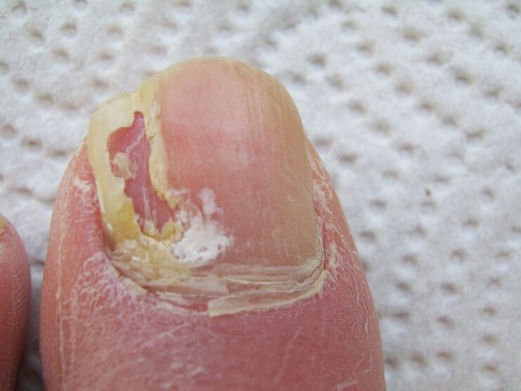 For onychomycosis, the nail plate will be deformed