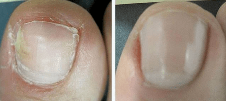 Toenails before and after fungal treatment