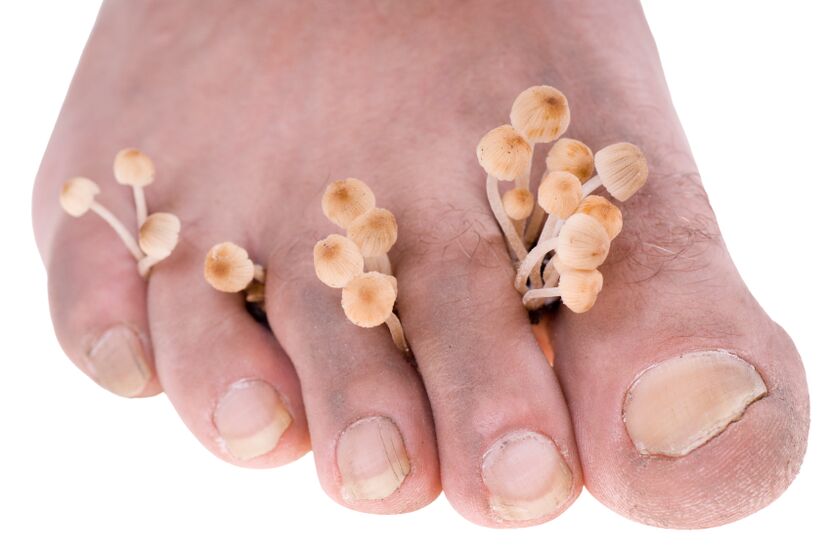 Fungus between the toes