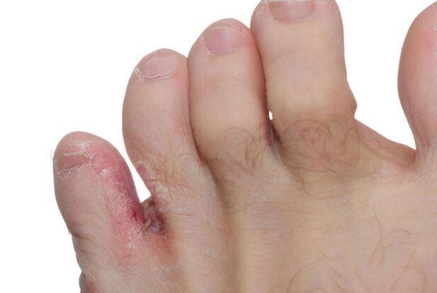 Symptoms of fungus between toes