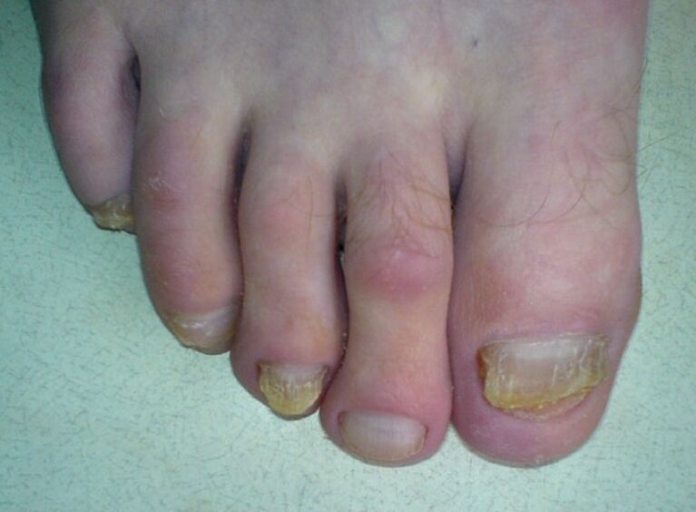 Nails turn yellow due to fungus