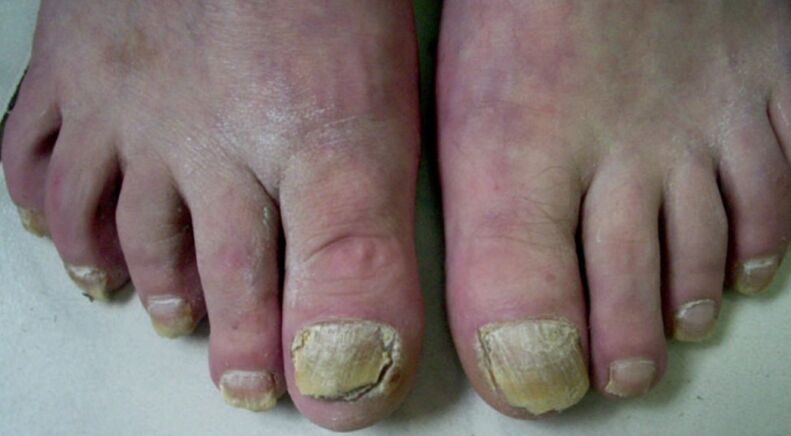 Neglected toenail fungus