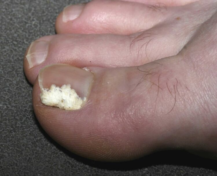 Superficial toenail fungus