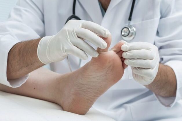 Doctor diagnoses foot fungus