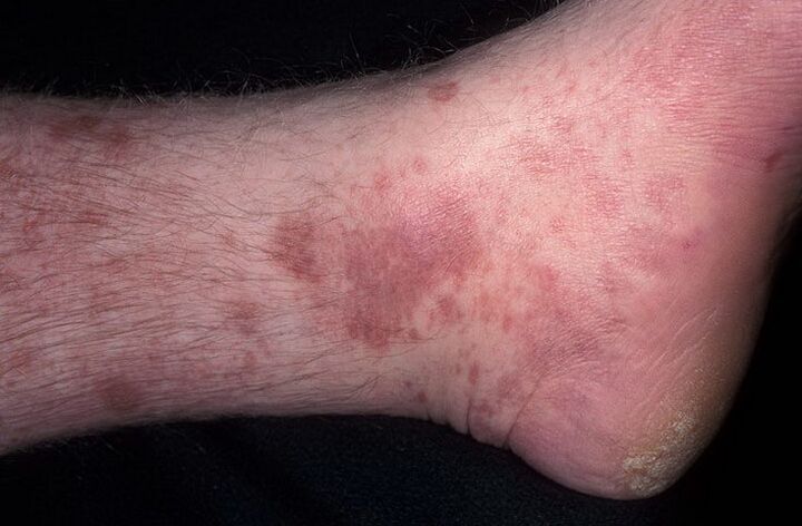 Fungal eczema on the legs