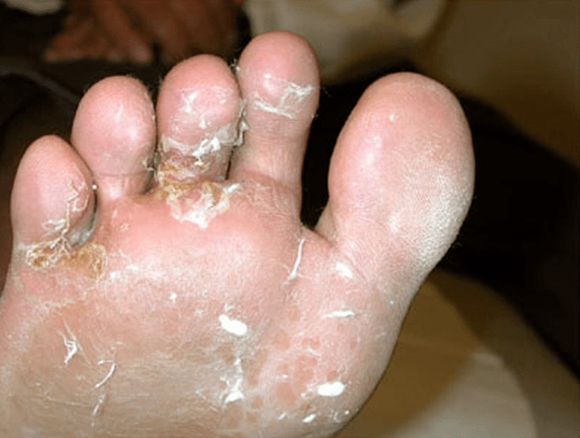 Fungus development on the toes