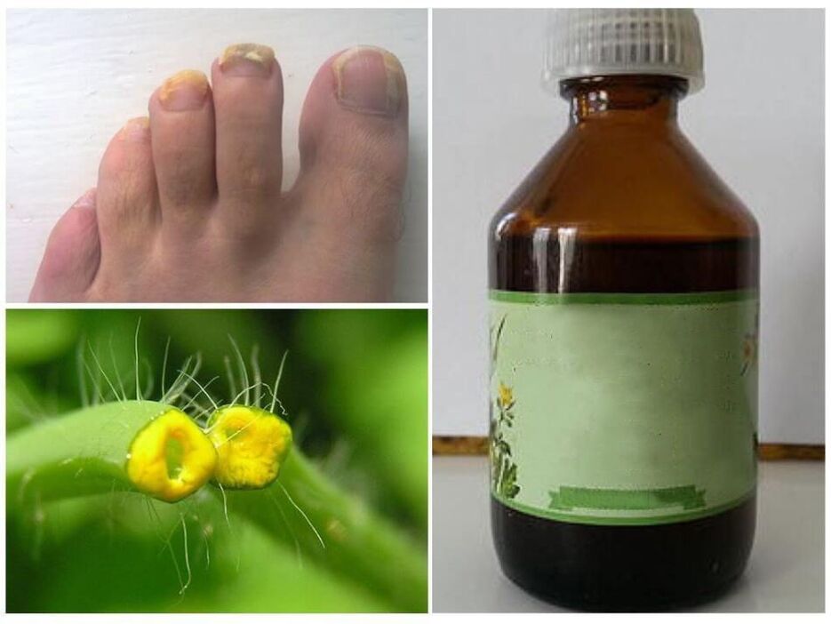 Celandine Juice Fights Nail Fungus