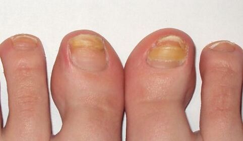 Fungus turns toenails yellow