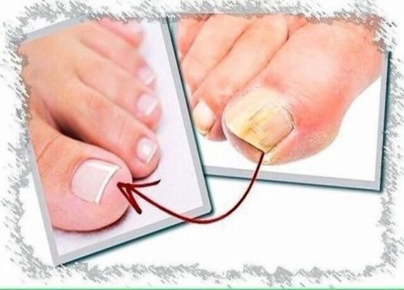 Toenail fungus before and after treatment