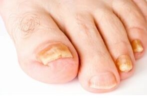 yellow toenail with fungus