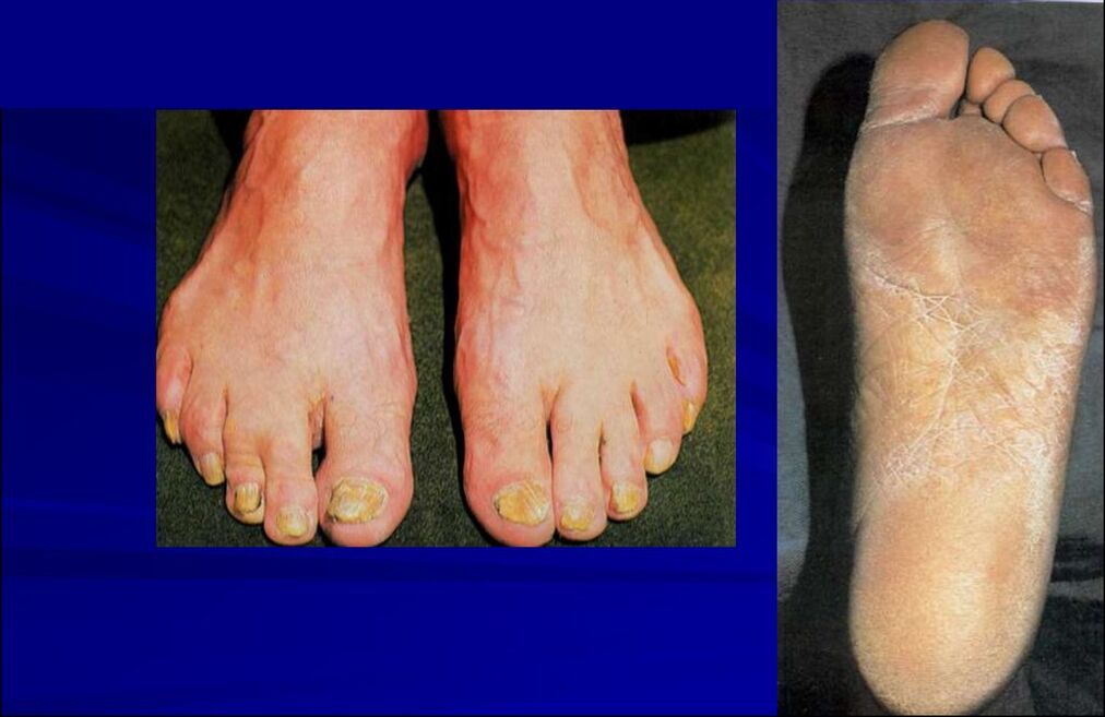 A scaly hyperkeratotic form of the fungus (erythromycosis of the foot)