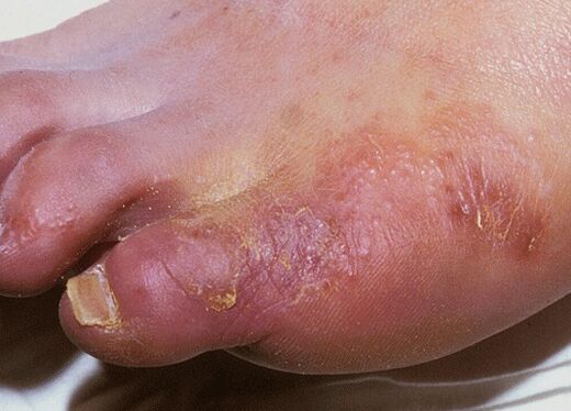 Example of foot fungal infection caused by Trichophyton interdigitae