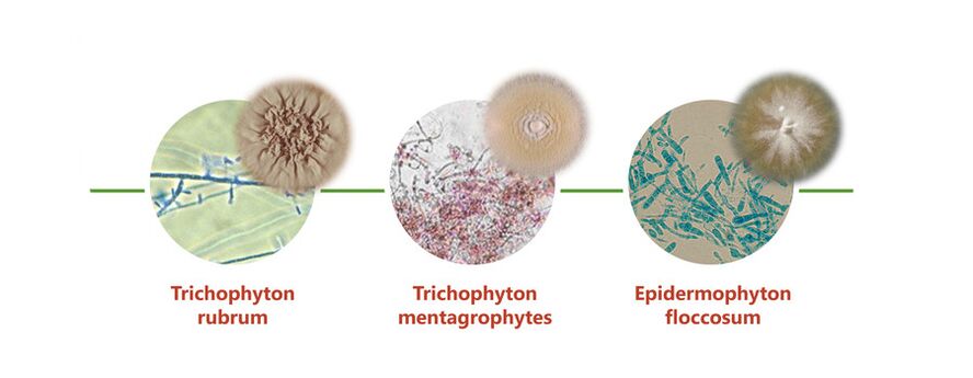 Main causative agent of dermatophytes on legs