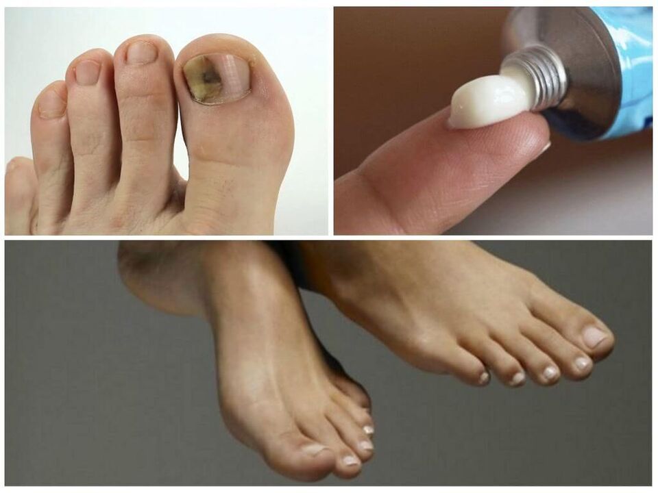 Creams against nail fungus