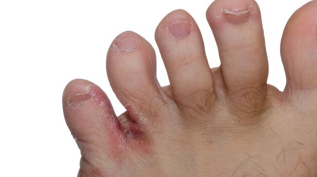 Signs of fungus between the toes - cracks and flaking of the skin