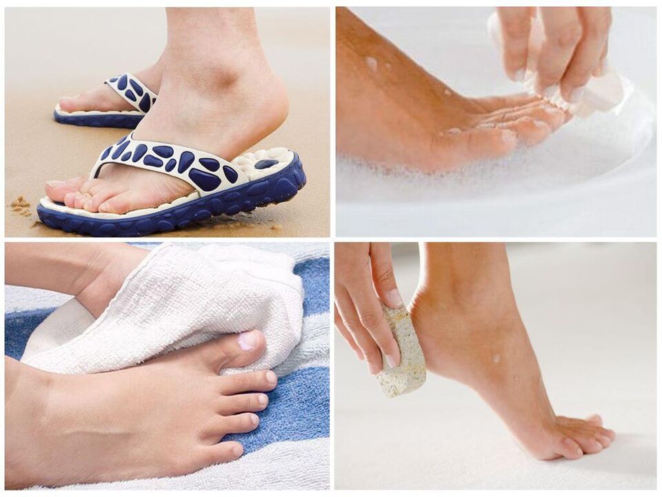 Prevention of onychomycosis includes foot hygiene, use of personal items, and prompt pedicures