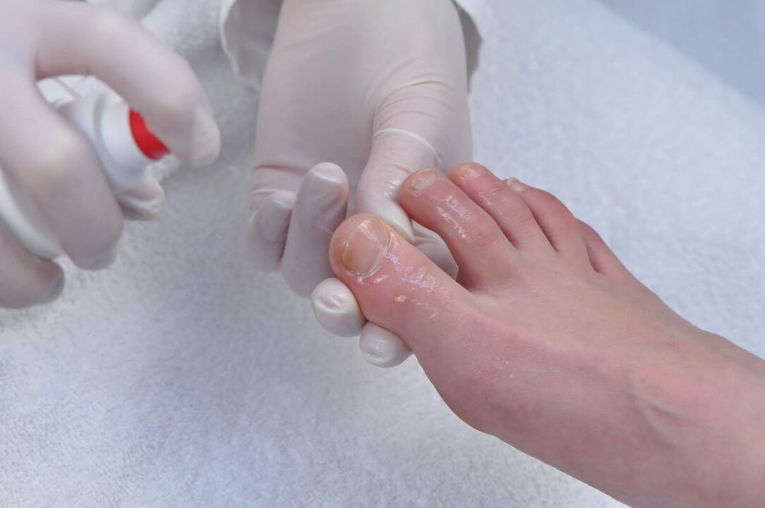 The initial stages of onychomycosis are reasons for a diagnostic examination by a dermatologist