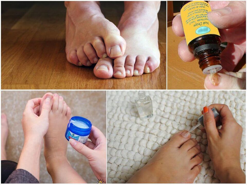 Treat toenail fungus with antifungal solutions, ointments, and varnishes