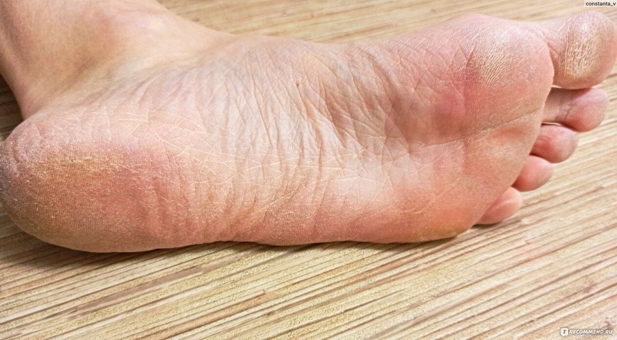 Fungus on human feet