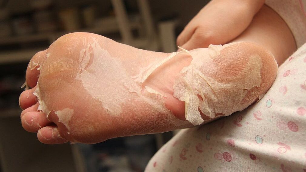 severe fungal infection of foot